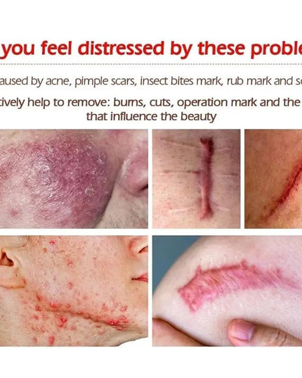 New Herbal Scar Repair Cream